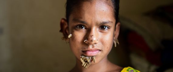 10χρονη από το Μπαγκλαντές ίσως είναι η πρώτη γυναίκα με το σύνδρομο «άνθρωπος δέντρο»