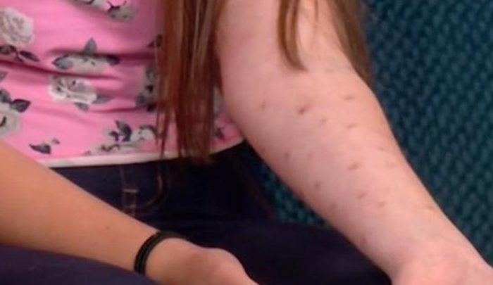 Νέα επικίνδυνη "μόδα" - Έφηβοι καίνε το δέρμα τους με αποσμητικό ! (video)