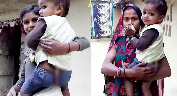 Παιδί στην Ινδία με 30 εκατοστά ουρά λατρεύεται ως μετενσάρκωση του Θεού της μαϊμούς