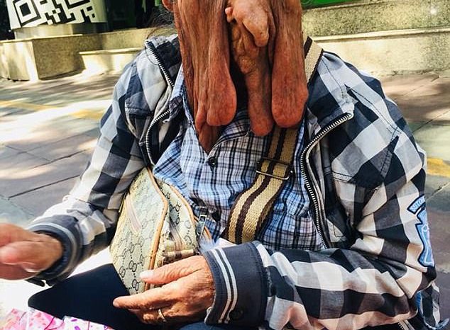 Αυτή η γιαγιά από την Ταϊλάνδη έχει αυτή τη σπάνια ασθένεια που λιώνει το πρόσωπό της